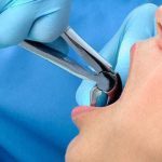 کشیدن دندان عقل؛ فیلم کشیدن دندان عقل نهفته و پوسیده و مراقبت های بعد از آن