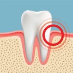 بلیچینگ و حساسیت دندانی پس از سفید کردن دندان ها و راه‌های درمان آن