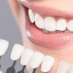 بهترین روش سفید کردن دندان ها با از بین بردن زردی دندان
