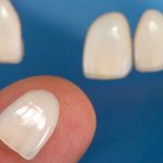 ونیر کامپوزیت دندان | مزایا، انواع، عوارض، طول عمر