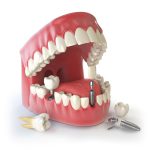 چه مدت بعد از کشیدن دندان میتوان ایمپلنت کاشت
