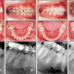 آیا می توان در حین ارتودنسی، دندان را عصب کشی کرد؟