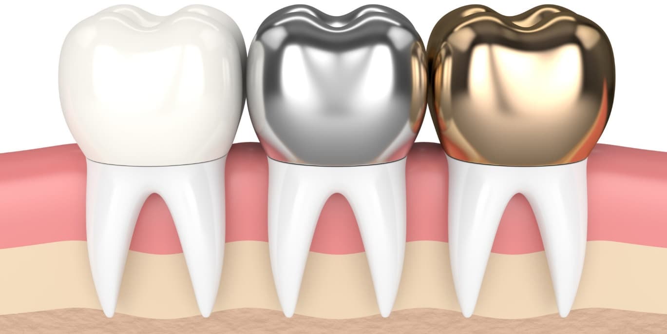 انواع روکش دندان چیست و در چه مواردی نیاز به روکش دندان است؟