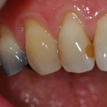 تغییر رنگ دندان بعد از عصب کشی