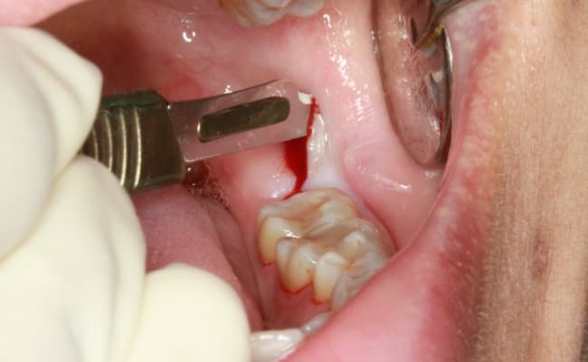 جراحی دندان؛ مراحل، عوارض و نکات مراقبتی قبل و بعد