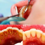 چه مواردی بر مدت زمان جرمگیری دندان اثر دارند؟