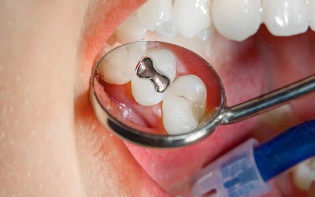 مراقبت از دندان بعد از ترمیم و پر کردن