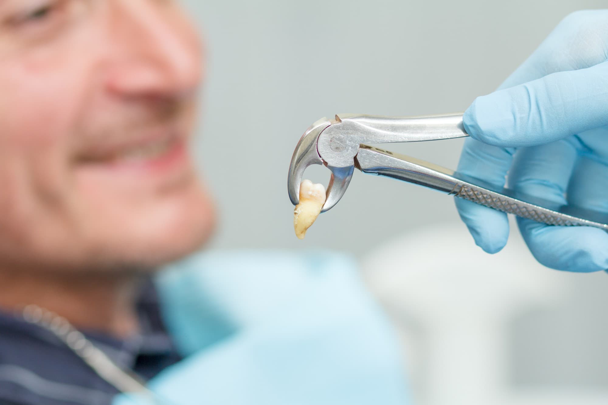 کشیدن دندان؛ دلایل و عوارض کشیدن دندان و مراقبت های بعد از آن