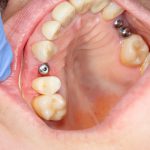 عفونت ایمپلنت دندان ؛ علائم و روش های درمان آن