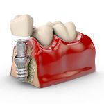 ایمپلنت دندان برای چه کسانی مناسب نیست؟