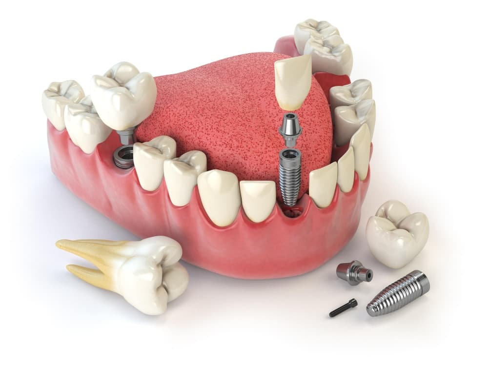علت های نیاز به تعویض ایمپلنت دندان