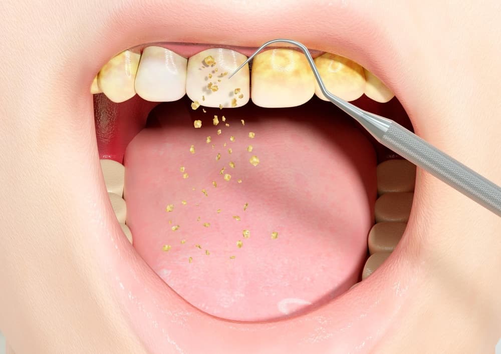 آیا جرم گیری دندان را خراب میکند؟