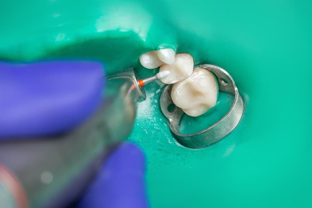 جدیدترین روش ترمیم دندان