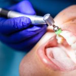 آیا جرم گیری دندان درد دارد؟