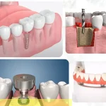 ایمپلنت دندان چند جلسه انجام و طول میکشد؟ {سخت ترین مرحله}