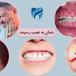 7 تا از علائم به عصب رسیدن دندان جلو و عقب چیست؟ [تشخیص تا درمان]