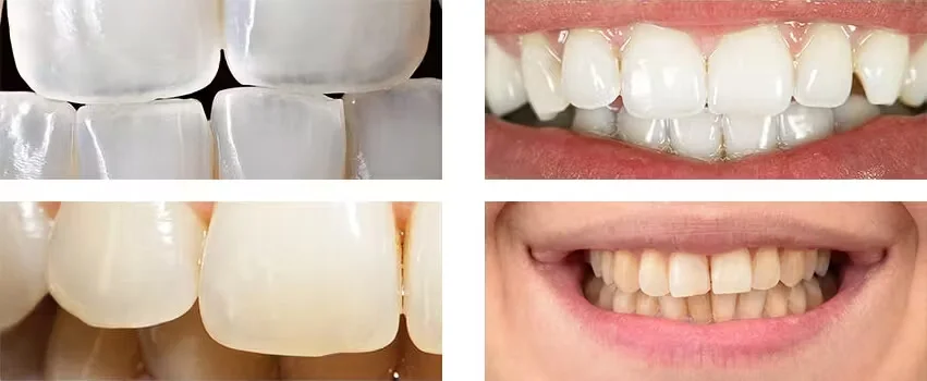 جرم گیری دندان چه مضراتی دارد