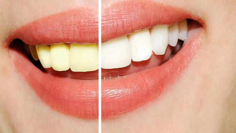 تاثیر جرمگیری روی تغییر رنگ و سفید شدن دندان
