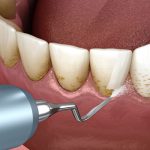فواید جرم گیری دندان چیست؟
